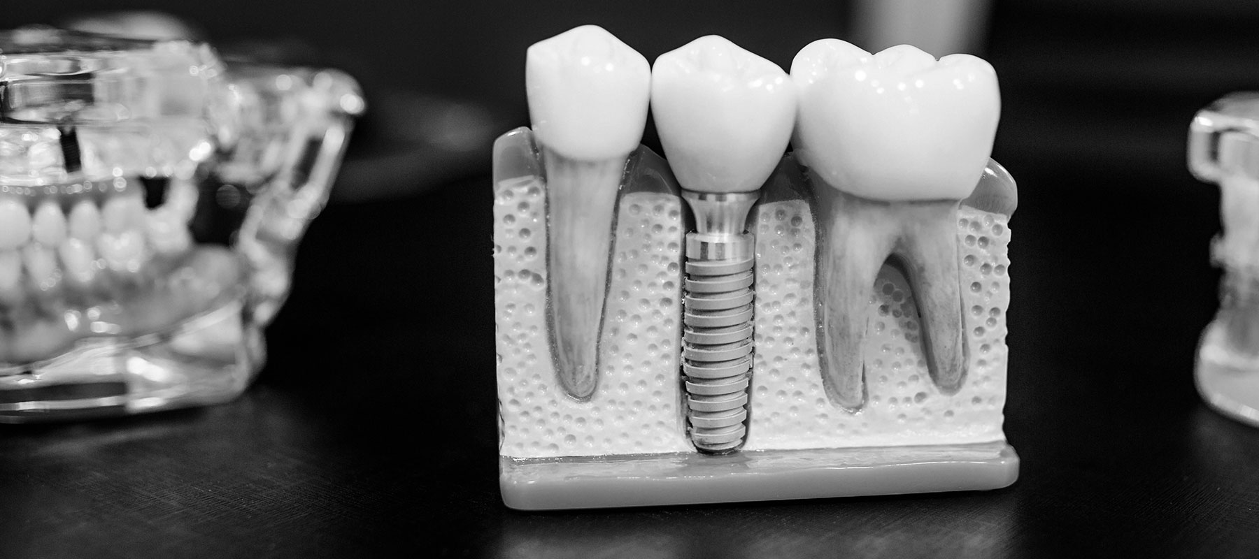dental implant model showing single implant placement into jawbone