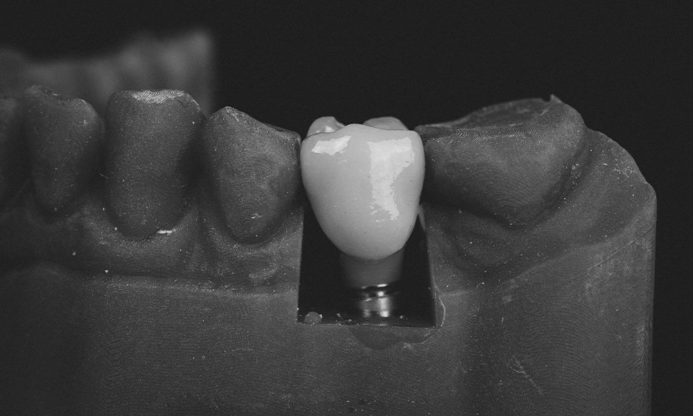Dental Implant FAQ: Everything You Need to Know