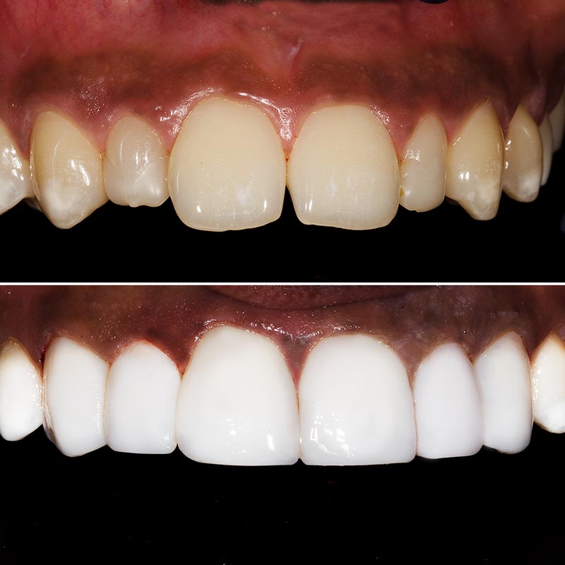 Before and after image of composite veneer treatment