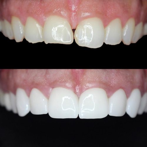 Porcelain Veneers on Harley Street Pro Dental Clinic