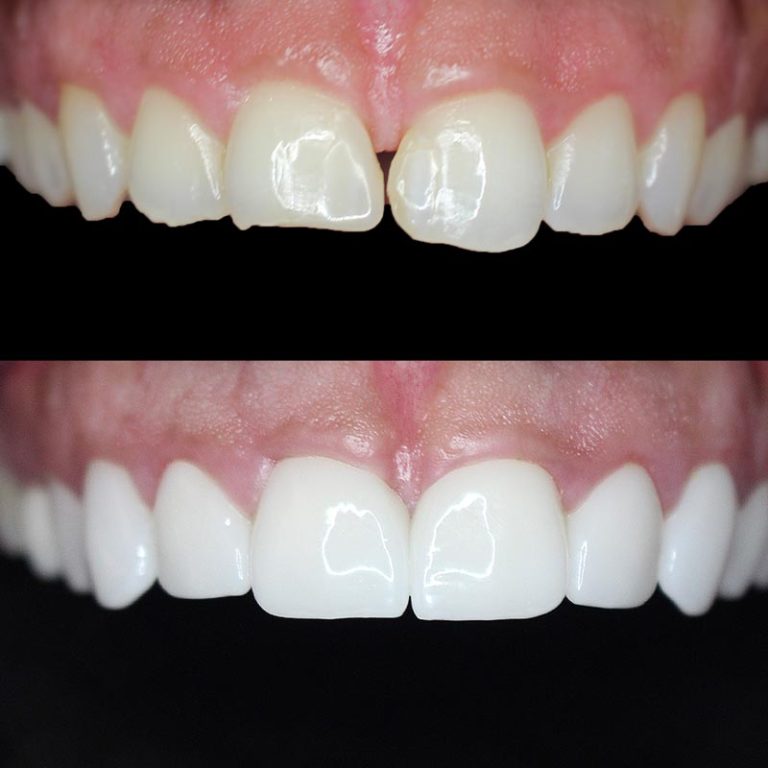 Porcelain Veneers on Harley Street Pro Dental Clinic