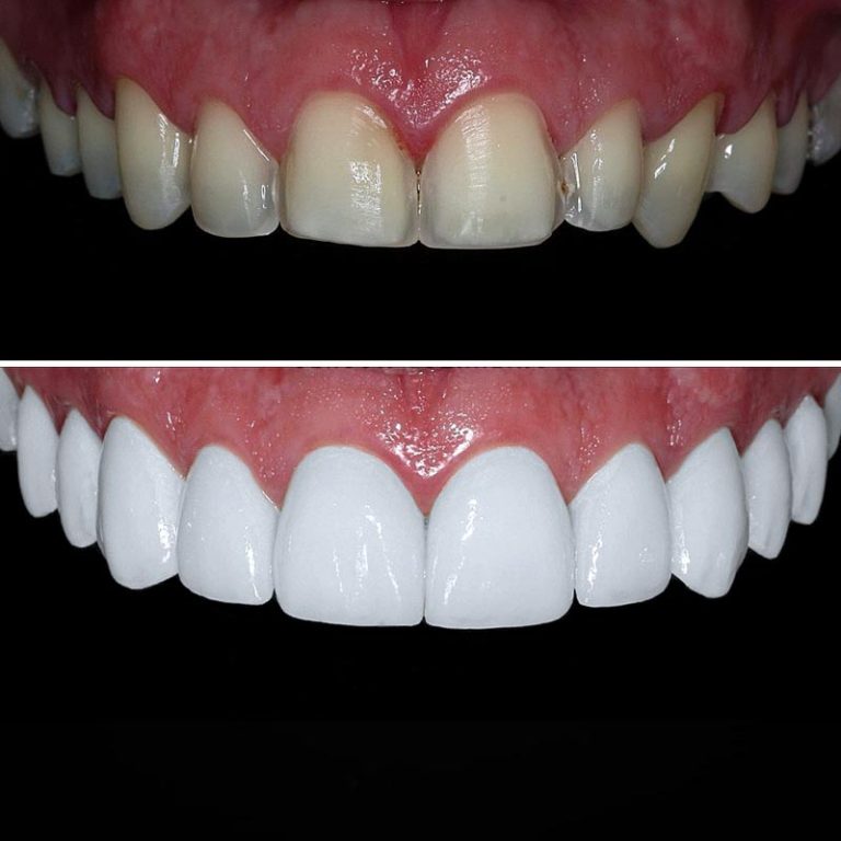 Porcelain Veneers on Harley Street Pro Dental Clinic