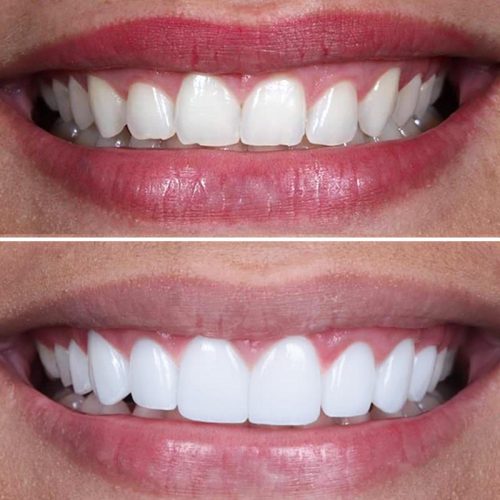 Porcelain Veneer before an afters by Pro Dental Clinic Harley Street