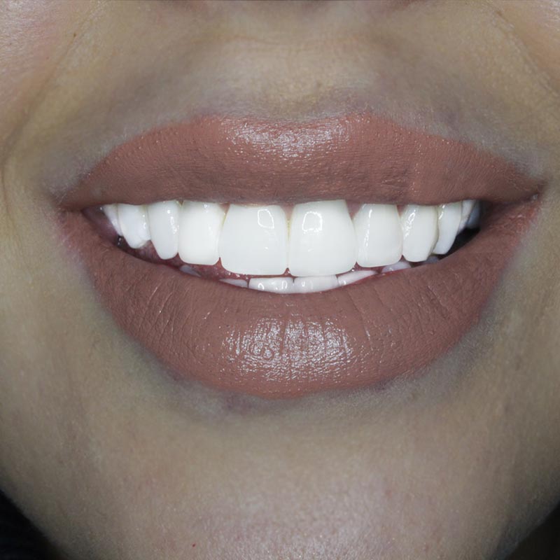 composite veneers 11 After image of composite bonding treatment