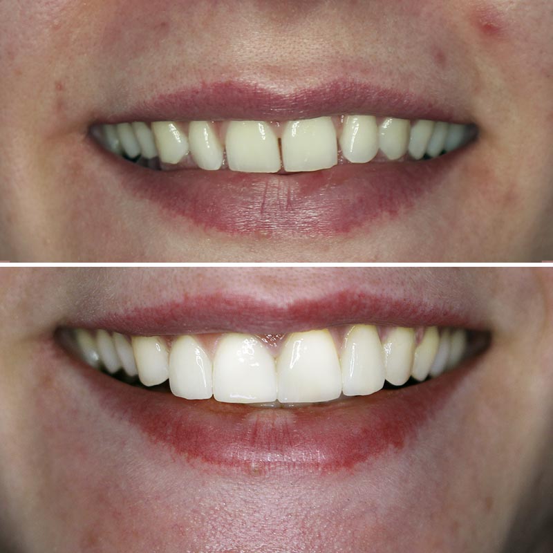 composite veneers 13 Before and after image of composite veneer treatment
