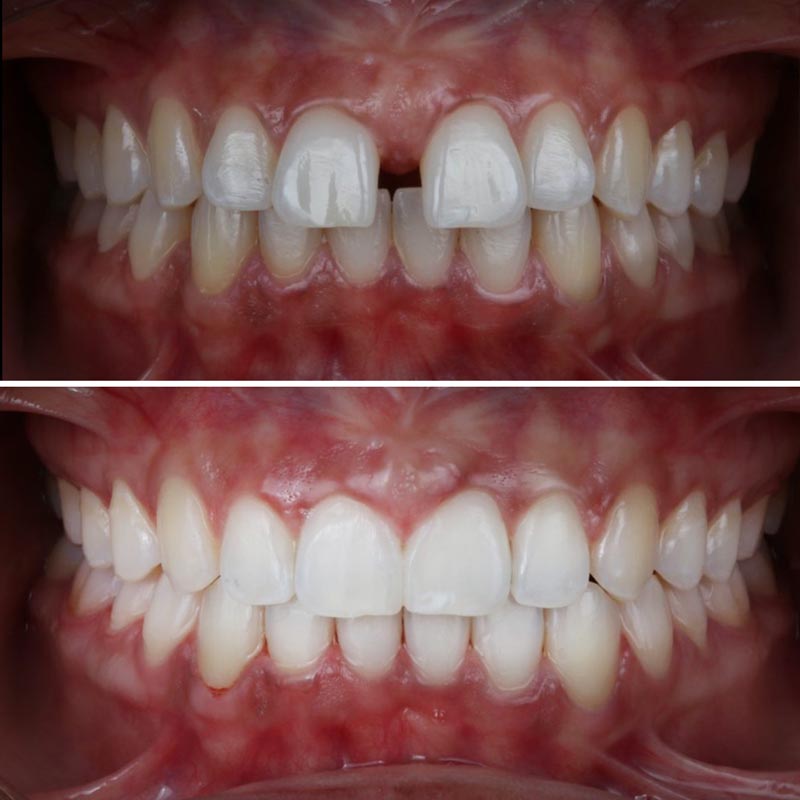 before and after image of teeth straightened by invisalign