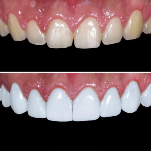 Porcelain Veneer before an afters by Pro Dental Clinic Harley Street