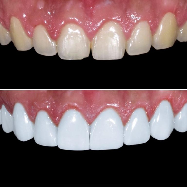 Porcelain Veneers on Harley Street Pro Dental Clinic