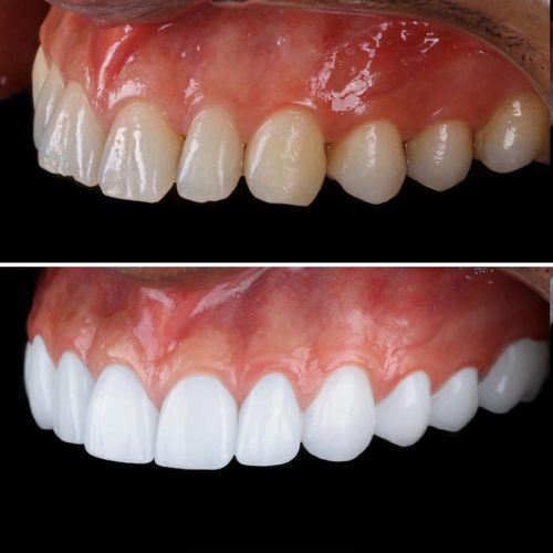 Porcelain Veneer before an afters by Pro Dental Clinic Harley Street