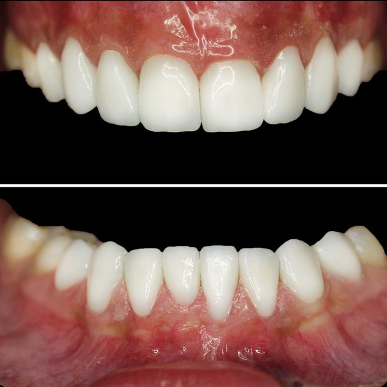 Porcelain Veneer before an afters by Pro Dental Clinic Harley Street