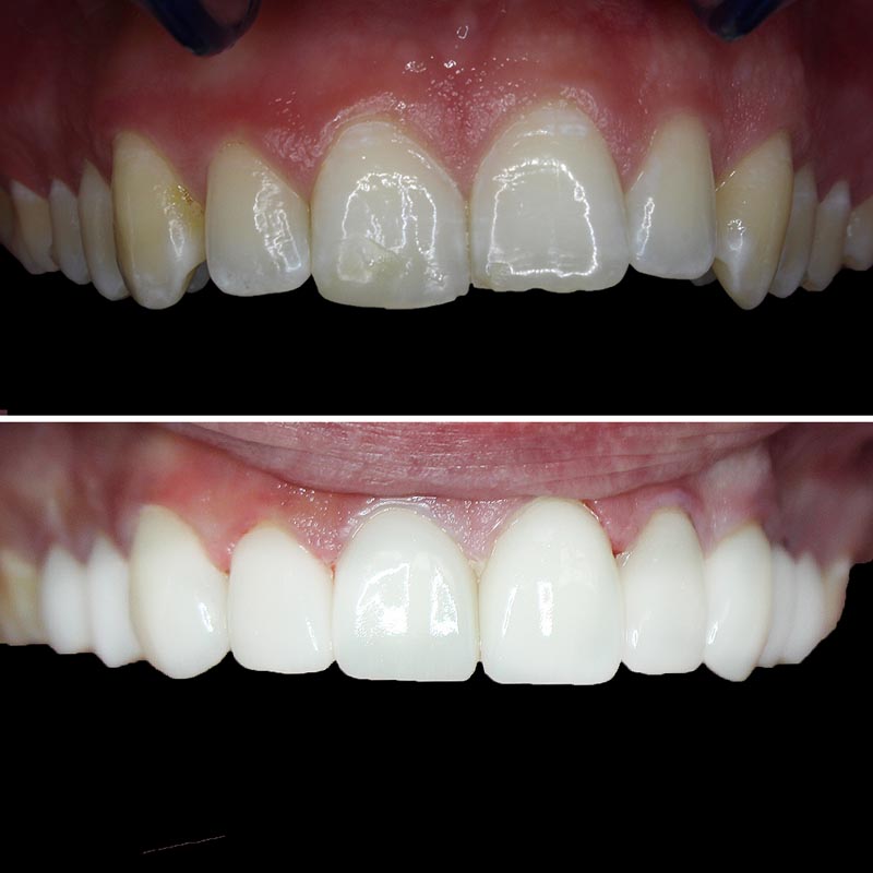 before and after image of upper teeth that have been corrected with porcelain veneers