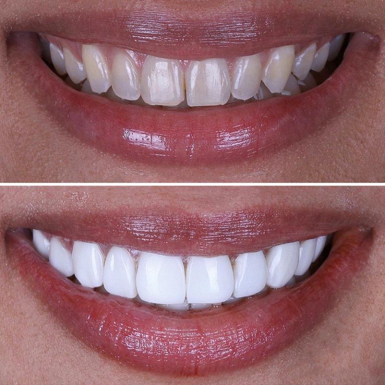 Porcelain Veneers on Harley Street Pro Dental Clinic