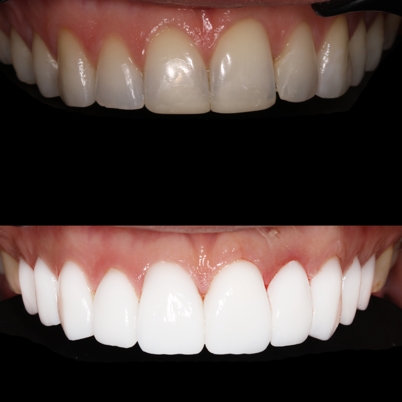Porcelain Veneer before an afters by Pro Dental Clinic Harley Street