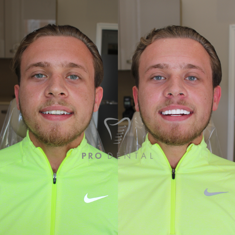 Composite Bonding Pro Dental Harley Street Composite Treatment