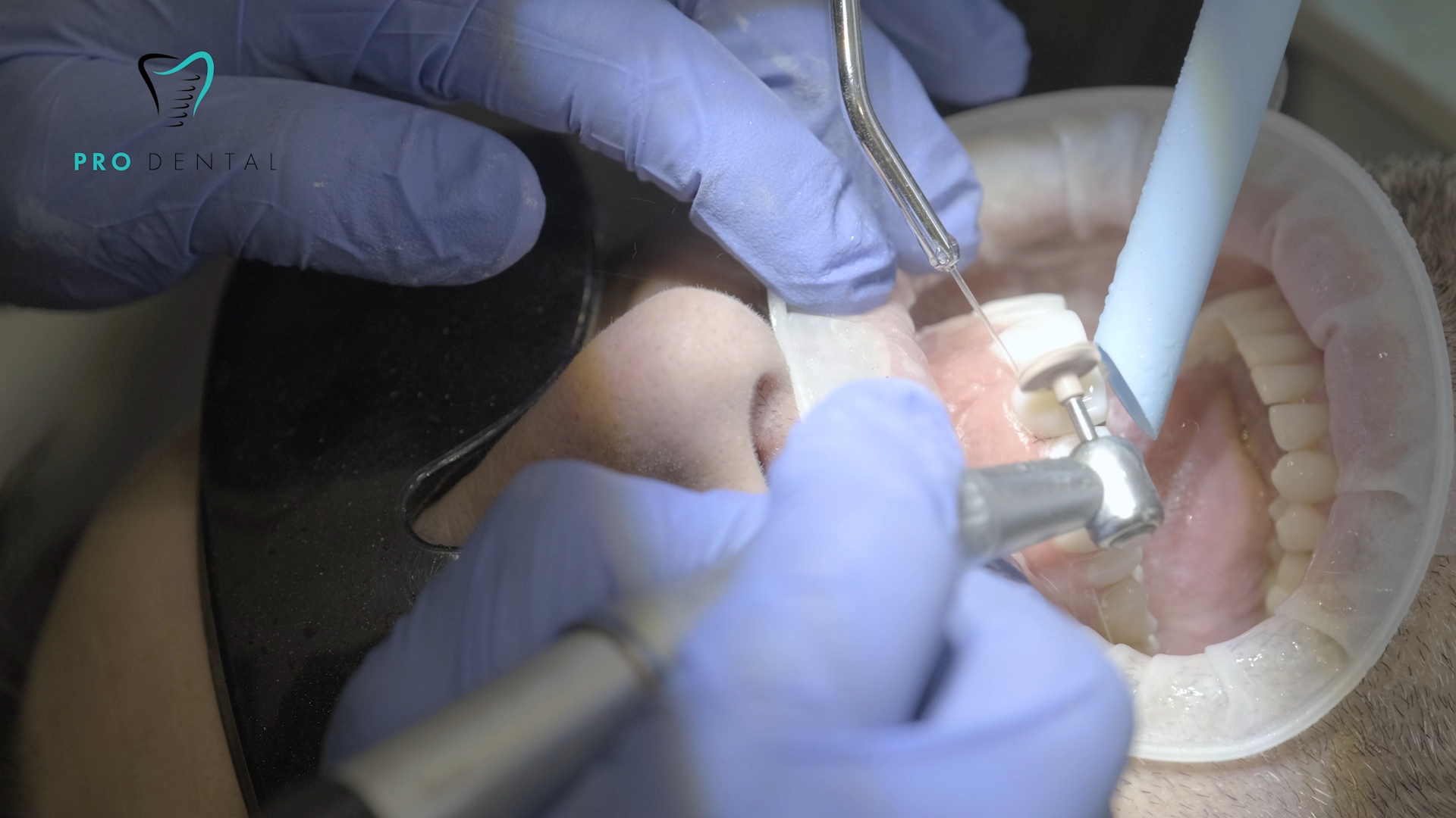 Composite veneers procedure