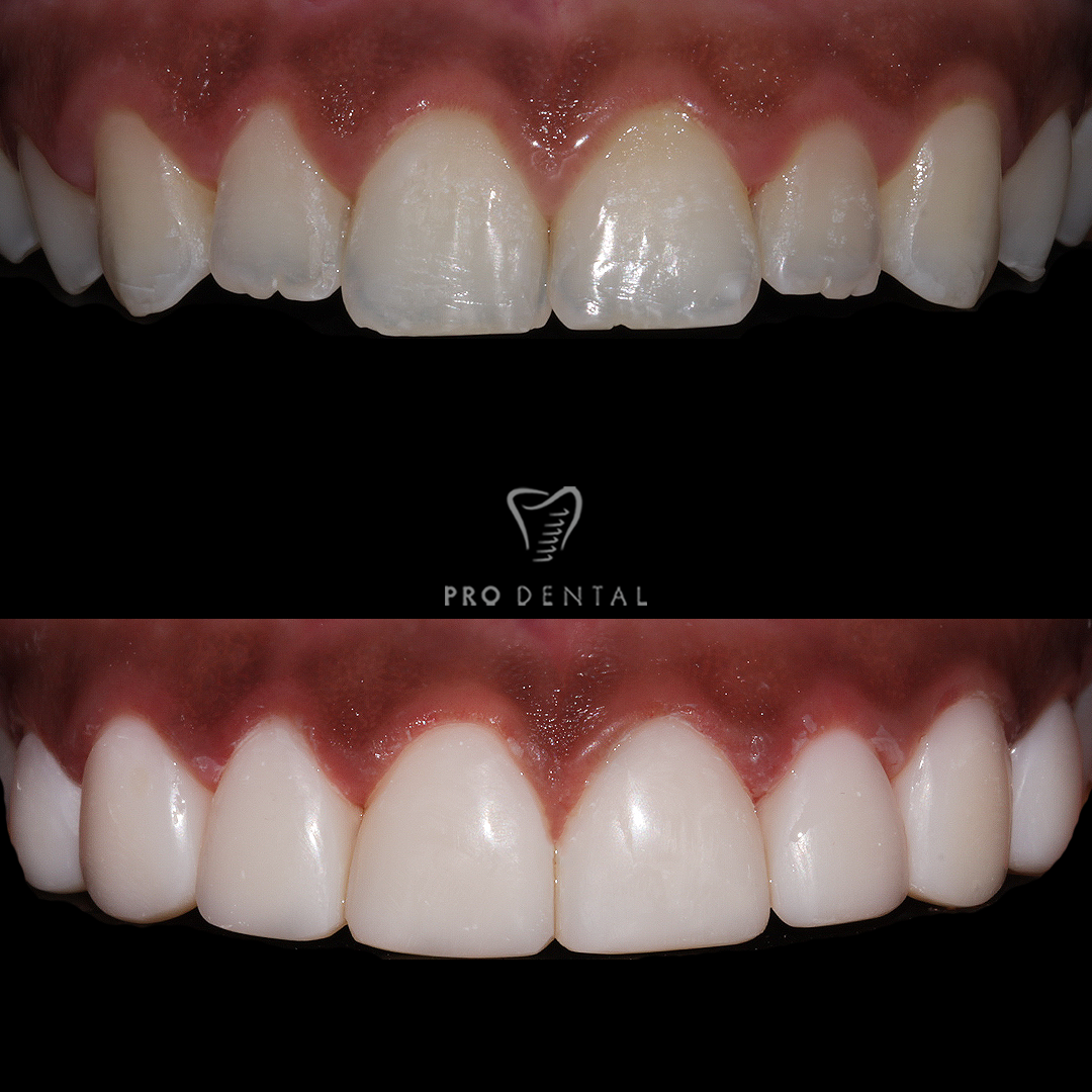 Composite veneers before and after