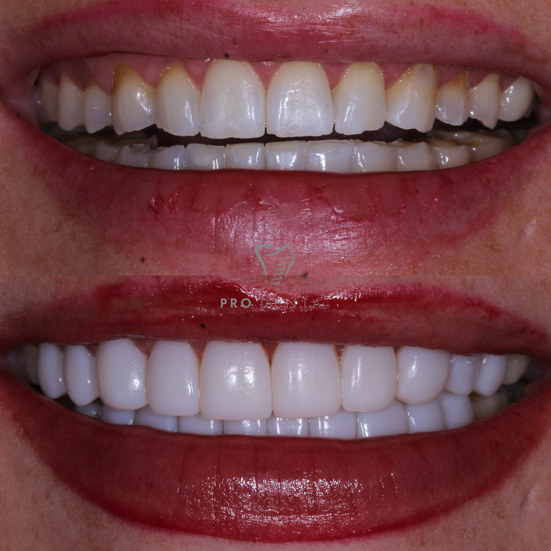 Composite Bonding Before and After Composite Bonding Before and After
