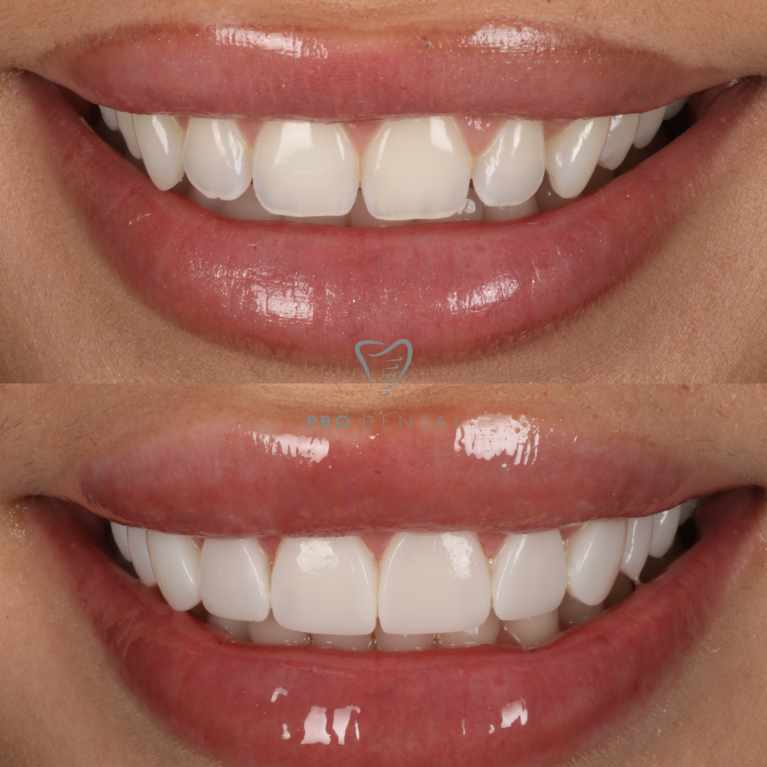 Composite Bonding Before and After