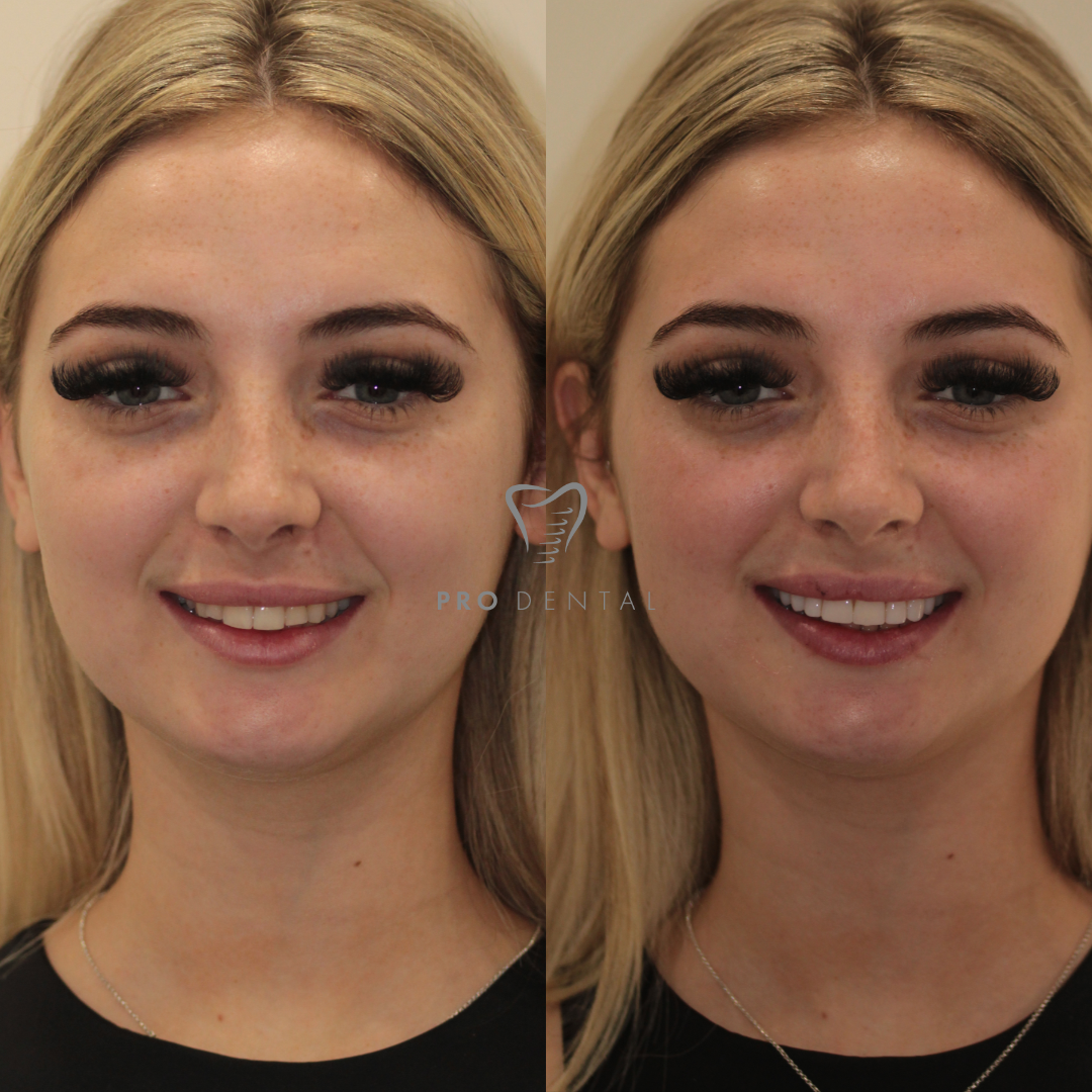 Composite veneers before and after Composite veneers before and after
