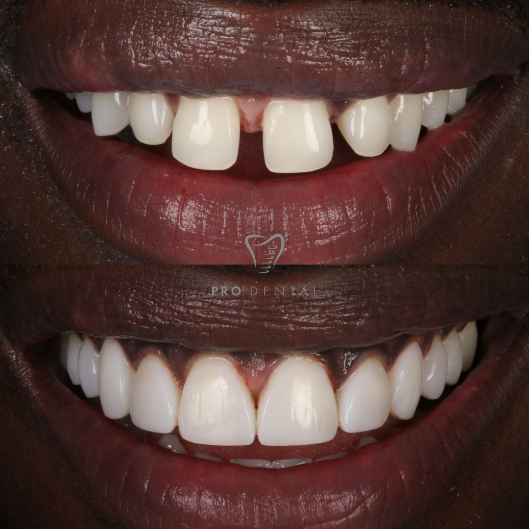 Composite Bonding Before and After Composite Bonding Before and After
