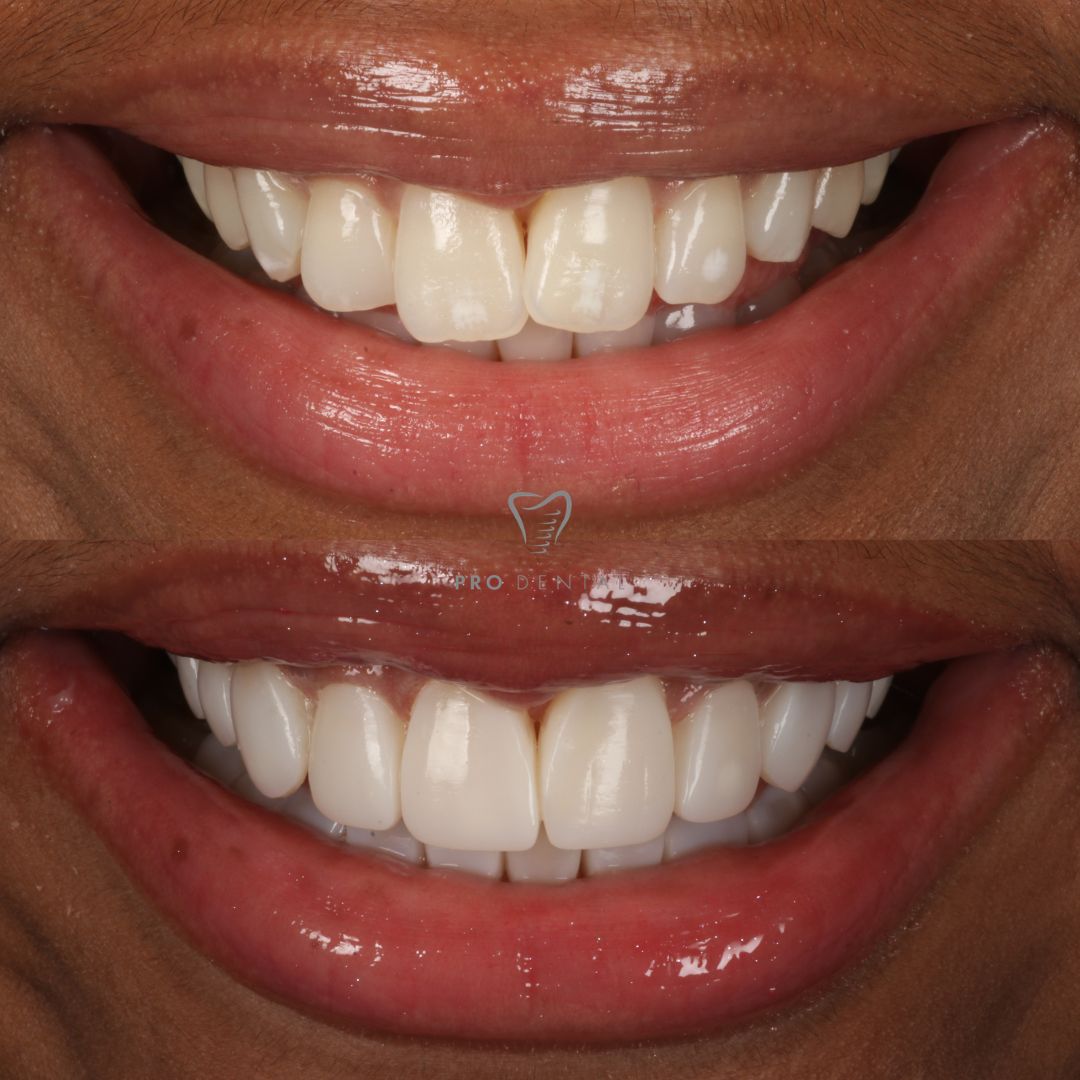Composite Bonding misaligned teeth