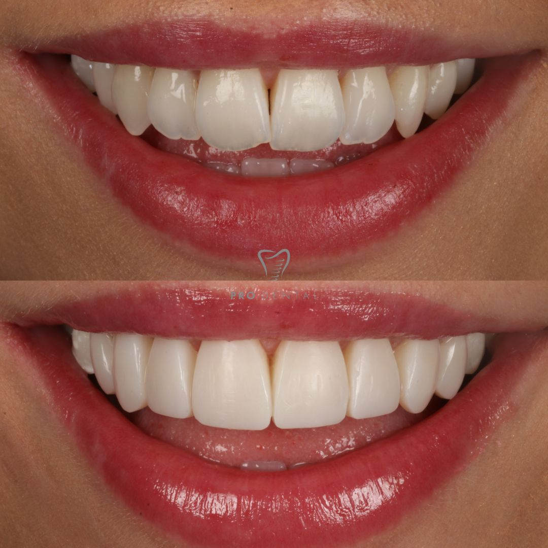 Composite Veneers overlapping teeth