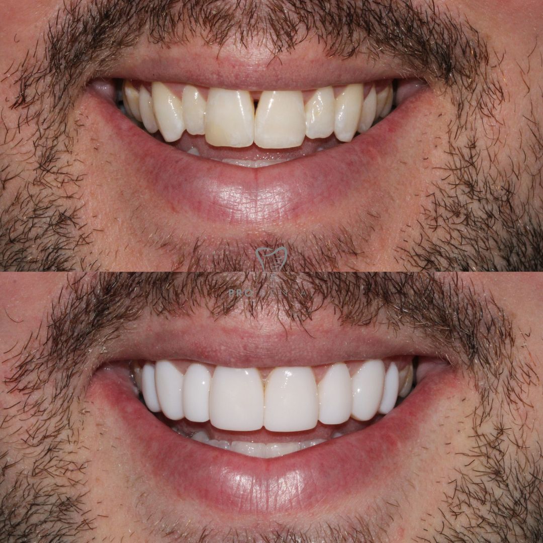 Composite bonding narrow smile