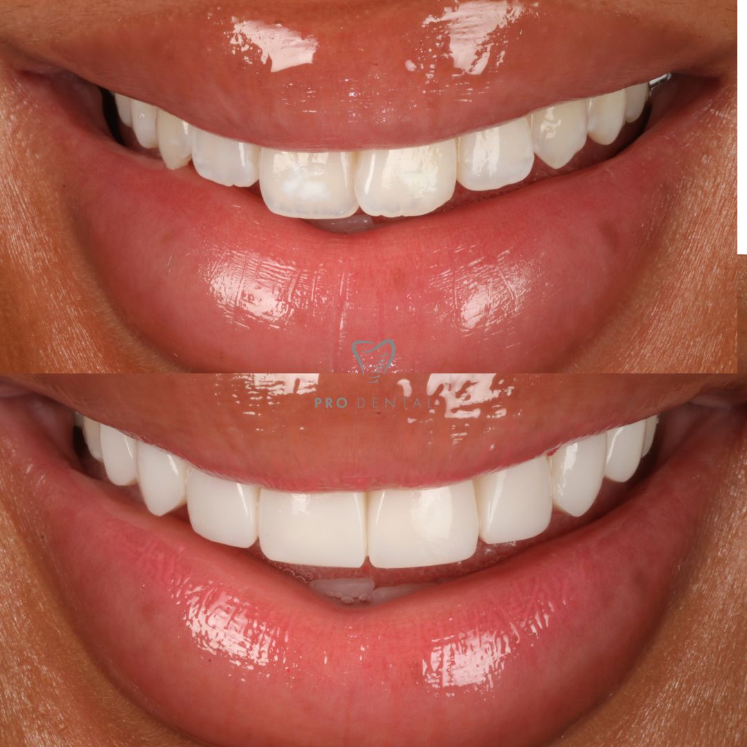 Composite bonding on overlapping teeth