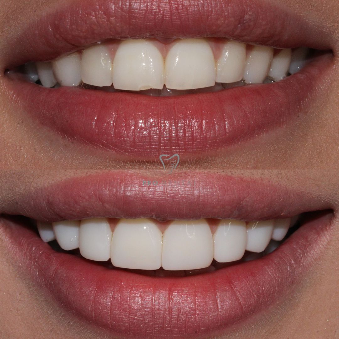 Composite bonding on slightly worn down teeth