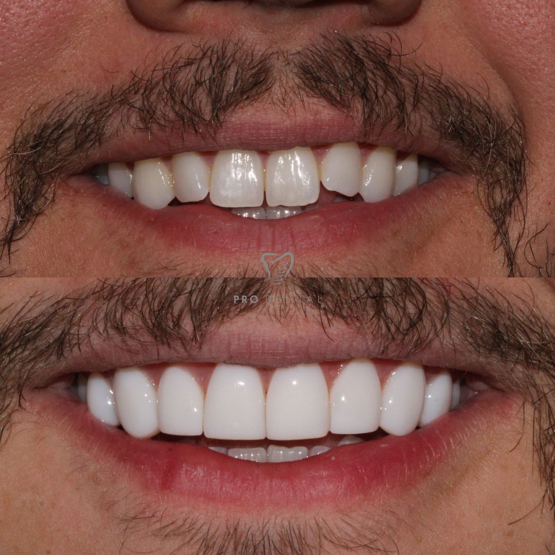 Composite bonding treatment on uneven teeth lengths