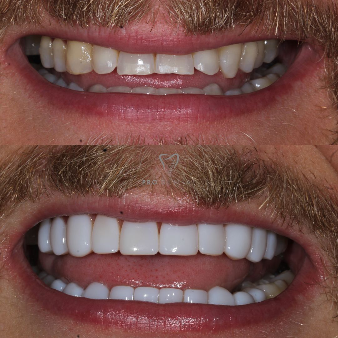 Composite on worn down and chipped teeth edges