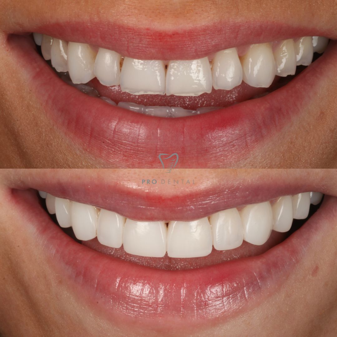 Composite on worn teeth edges