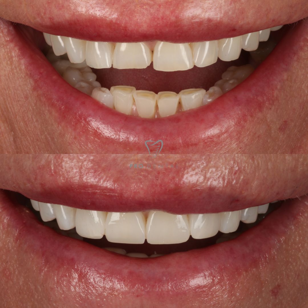 Composite veneers on chipped and worn down teeth