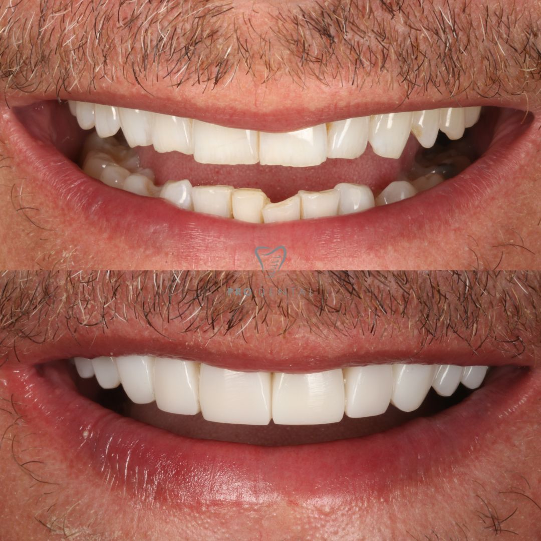 Composite veneers on worn down teeth edge