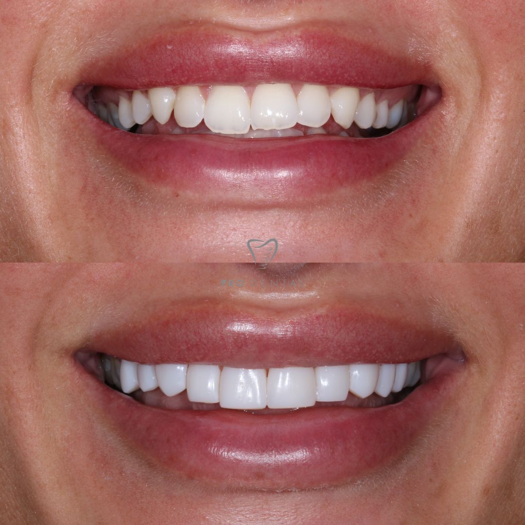 Compositet bonding uneven teeth