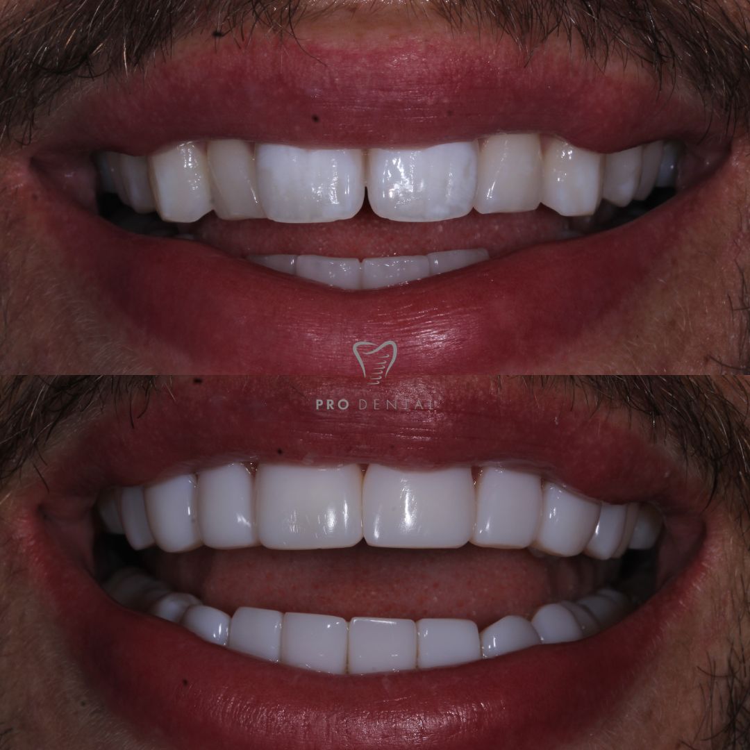 Copmosite bondng on discloured teeth and narrow smile